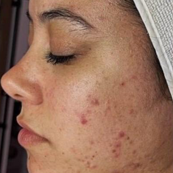 Acne before